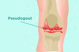 Pseudogout