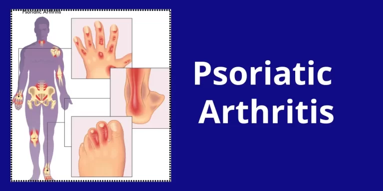 Psoriatic Arthritis