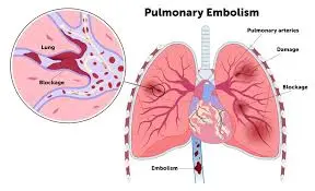 pulmonary embolism