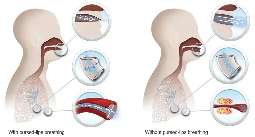 Pursed lip breathing in COPD patients