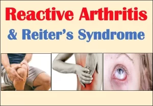 Read more about the article Reactive Arthritis