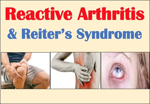 Reactive Arthritis