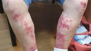 Rheumatoid Arthritis Rashes