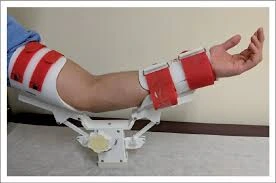 Splinting post traumatic elbow stiffness