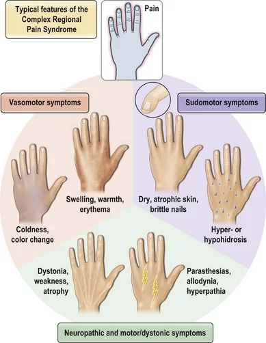 Stages of CRPS syndrome