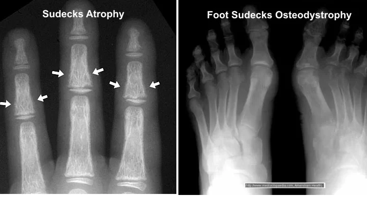 Sudeck's Atrophy (Complex Regional Pain Syndrome)