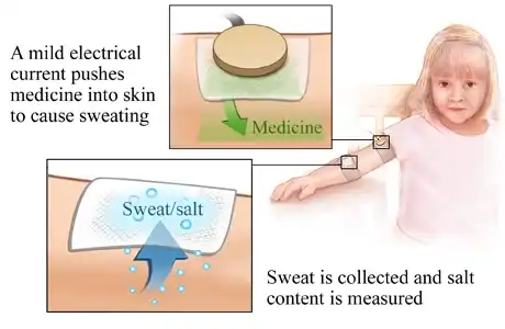 Sweat test