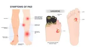 Symptoms-of-PAD