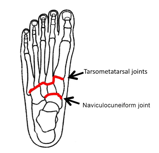 Tarsometatarsal joints