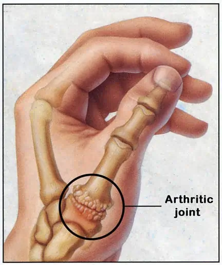 Thumb Arthritis