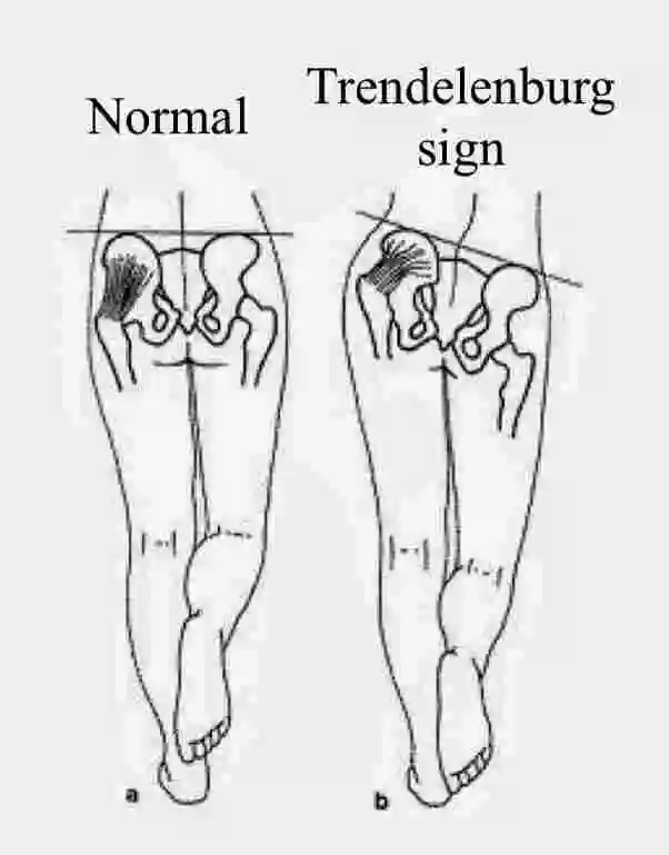 Trendelenburg Sign