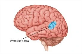 Wernicke’s Aphasia