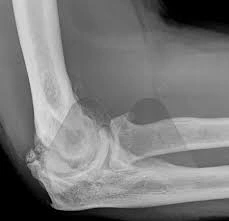 X ray for elbow stiffness