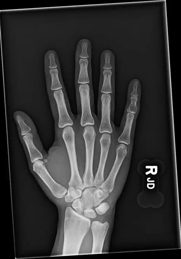 X-ray for pyogenic flexor tenosynovitis