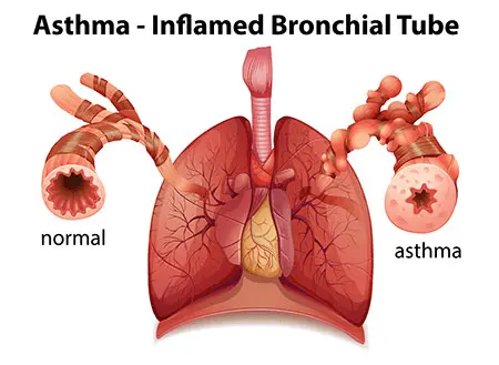 Asthma