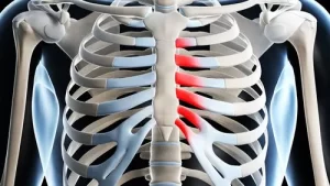 Read more about the article Costochondritis