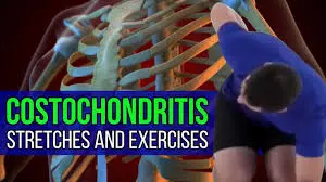 Costochondritis-physical-exercise