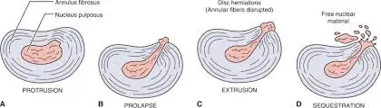 disc-herniation-stages-explained