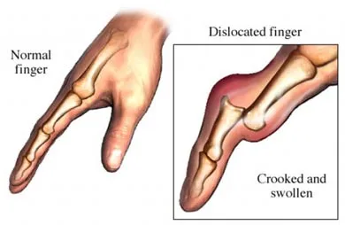 Finger-dislocation