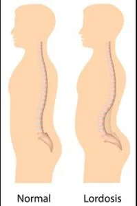 lordosis