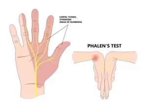Read more about the article Phalen’s Test
