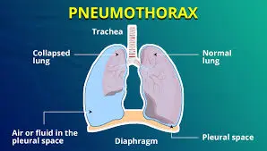 pneumpthorax-diagram