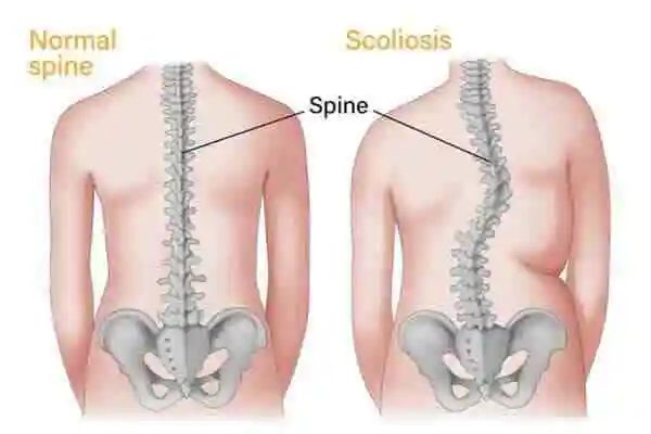 scoliosis