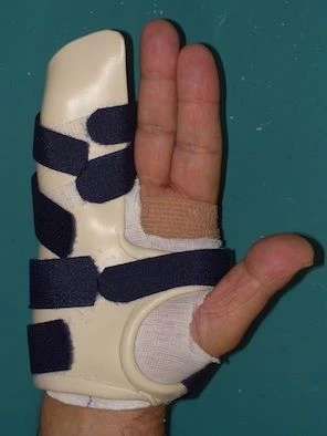 Splint for palmar aponeurosis