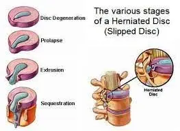 stages-of-disc-herniation