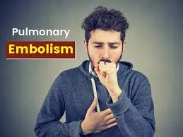 Symptom-of-pulmonary-embolism