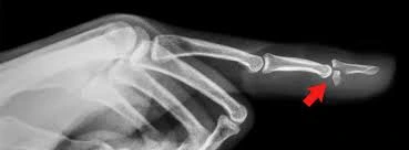 X ray for jersey finger