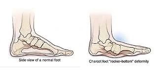 A rocker-bottom foot deformity