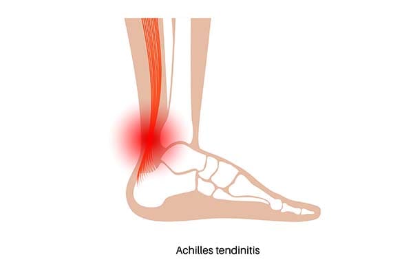 Achillis tendinitis