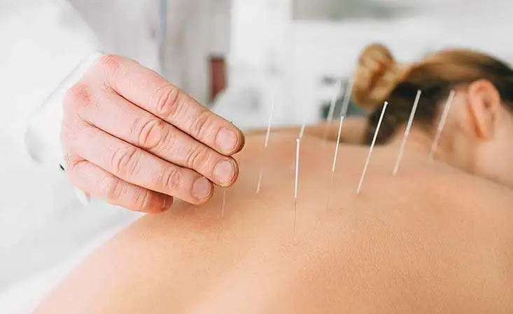 Acupuncture