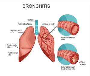Read more about the article Bronchitis