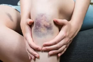 Read more about the article Bruises (Ecchymosis)