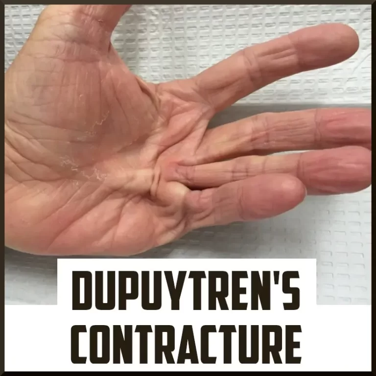 Dupuytren’s contracture