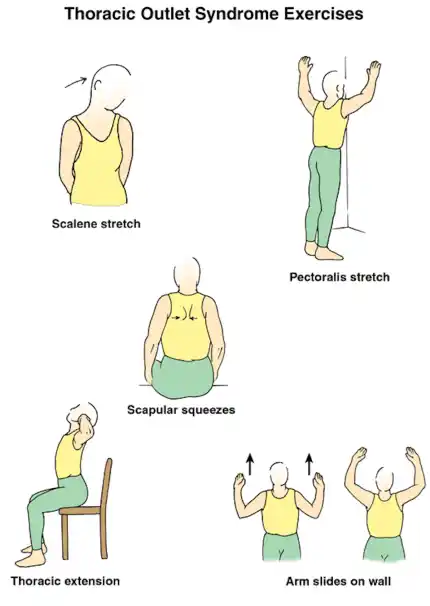 Exercise for thoracic outlet syndrome