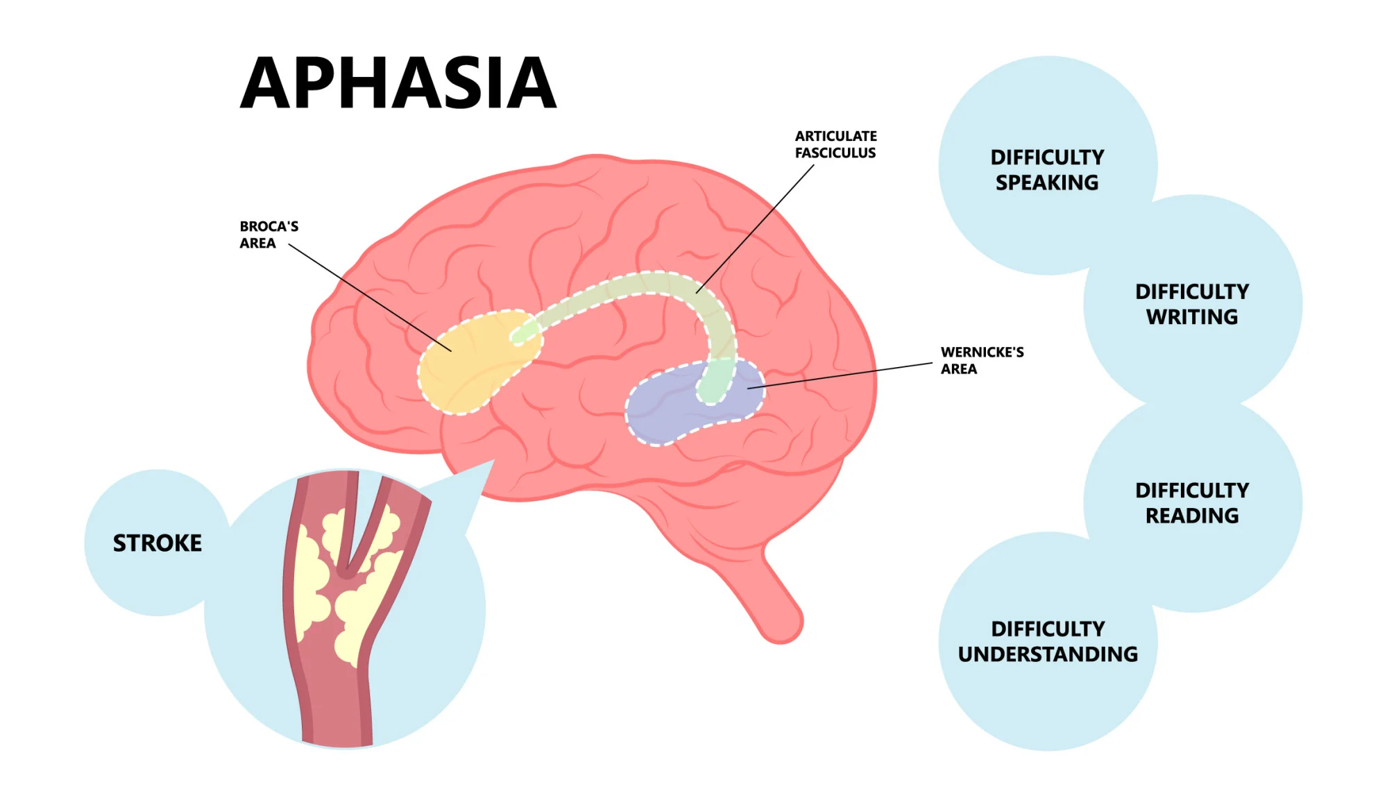 Global Aphasia vs Expressive Aphasia