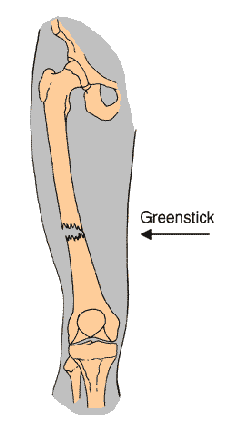 Greenstick fracture