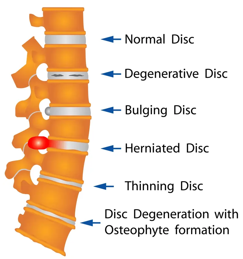 How Did I Cure My Degenerative Disc Disease