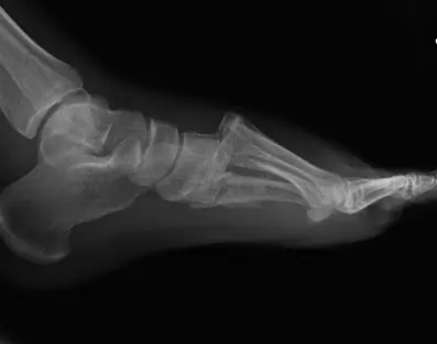 Lisfranc injury