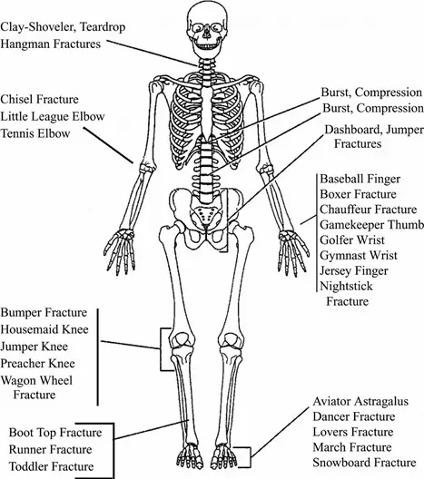 List of Common Fractures in Human Body