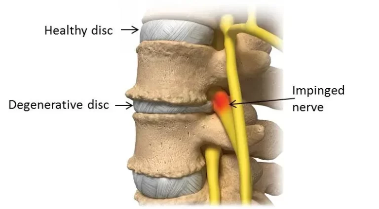 Lumbar degenerative disc disease