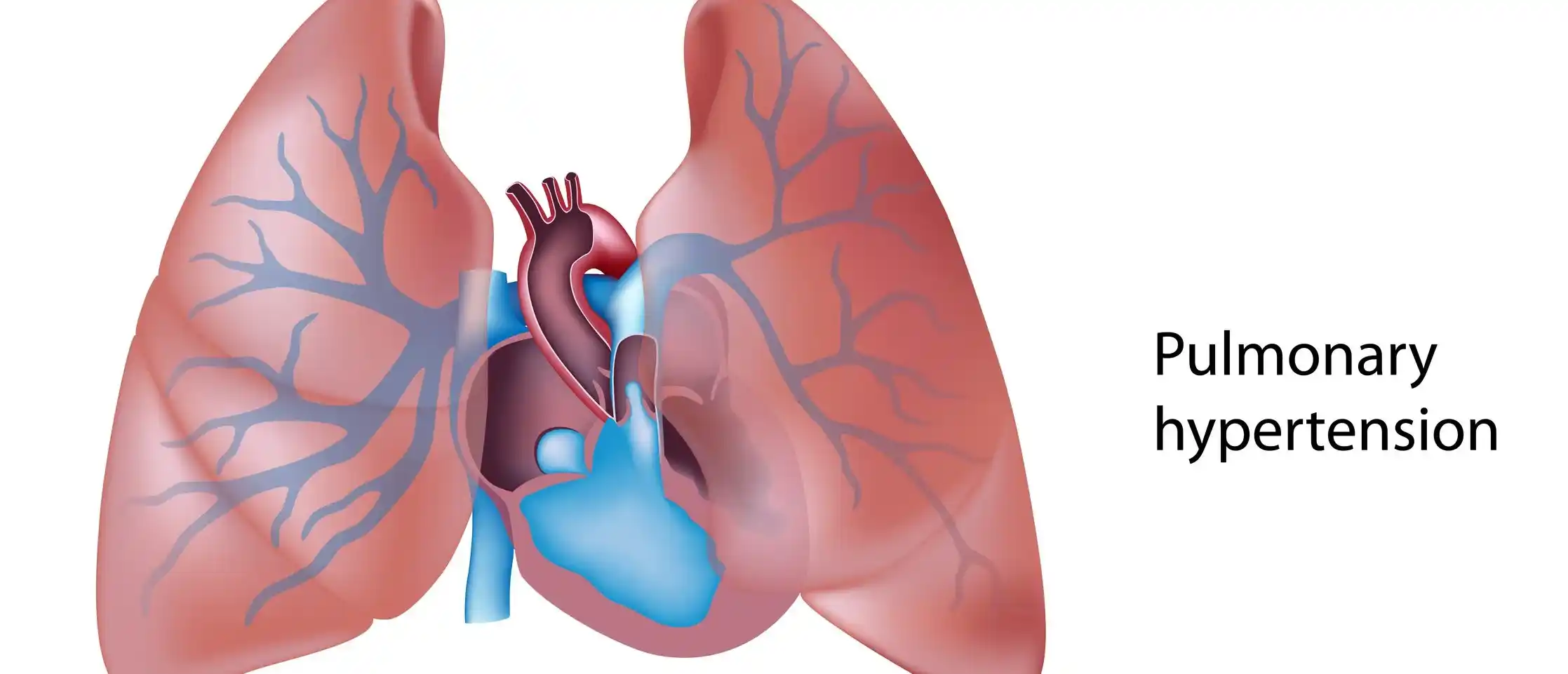 Pulmonary Hypertension