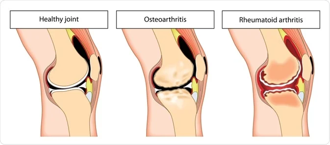 Rheumatoid Arthritis vs Osteoarthritis