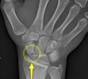 Scaphoid Fracture