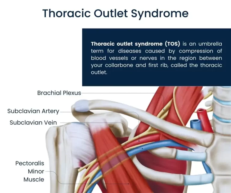 Thoracic outlet syndrome