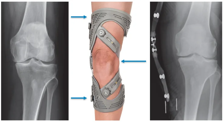 Unloader Knee Brace for Osteoarthritis