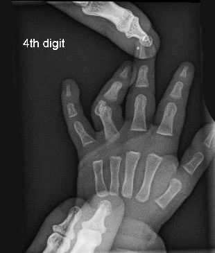 X-ray-OF-Camptodactyly